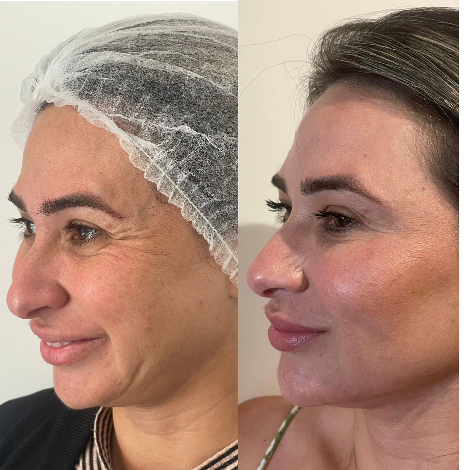 Harmonização Facial